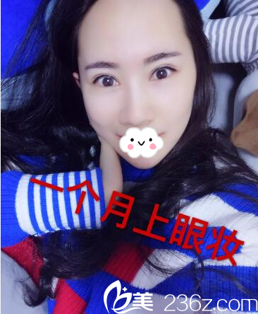 找何为院长做完双眼皮1个月自拍 找何为院长做完双眼皮1个月自拍