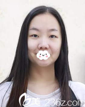 术前单眼皮照片 术前单眼皮照片