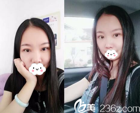 广东揭阳割双眼皮哪家医院好？揭阳华美双眼皮的价格不贵技术还好哦