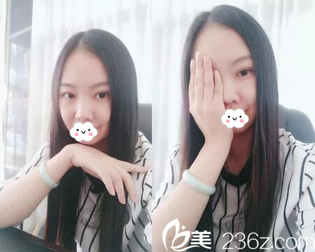 揭阳华美张旭医生双眼皮样子 揭阳华美张旭医生双眼皮样子