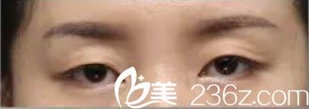 在宁德华美整形医院做双眼皮术前照 在宁德华美整形医院做双眼皮术前照
