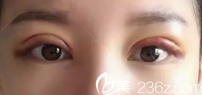 全切双眼皮术后第4天就基本消肿了 全切双眼皮术后第4天就基本消肿了