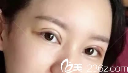 让<!--<i data=20240703-sp></i>-->生做全切双眼皮术后第6天的照片 让<!--<i data=20240703-sp></i>-->生做全切双眼皮术后第6天的照片