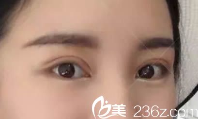 割完切开双眼皮术后15天效果图 割完切开双眼皮术后15天效果图