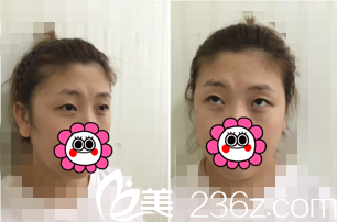 双眼皮修复前照片 双眼皮修复前照片