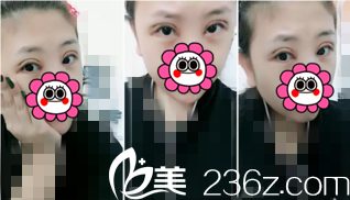 术后天样子 术后天样子