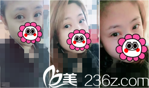 术后第八天来院拆线 术后第八天来院拆线