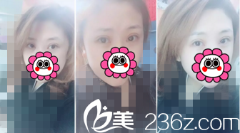 术后半个月恢复情况 术后半个月恢复情况