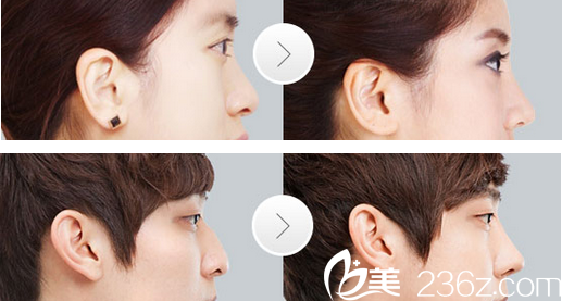 整形美容医院假体隆鼻案例 整形美容医院假体隆鼻案例