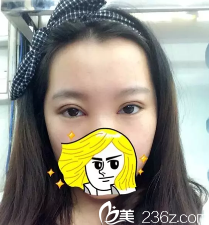 双眼皮手术4天还有些肿胀 双眼皮手术4天还有些肿胀