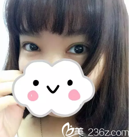 双眼皮7天拆线效果 双眼皮7天拆线效果