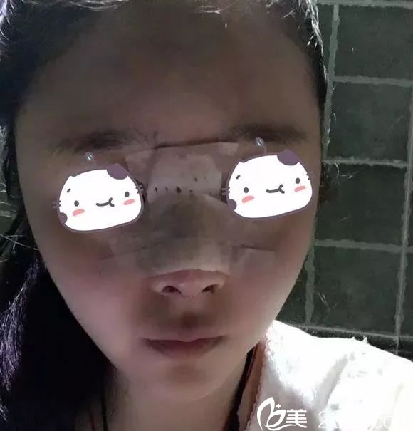 在建国整形做鼻综合第1天