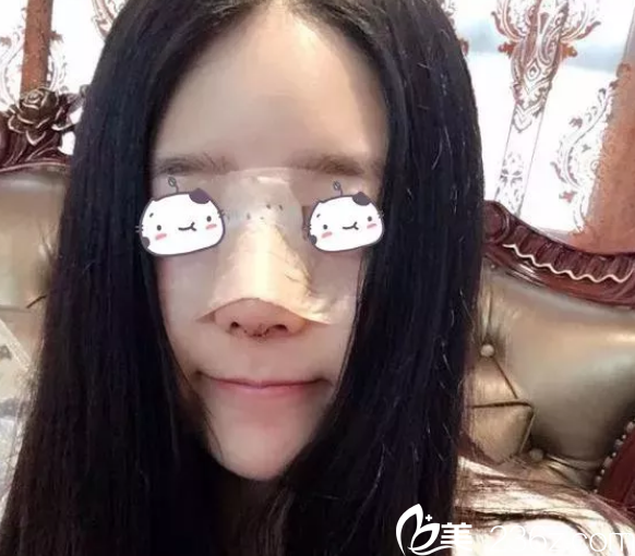 做完隆鼻手术第2天恢复照