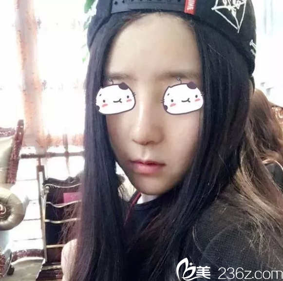 徐建国耳软骨隆鼻手术<span style=