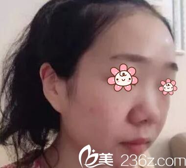 到新疆黎美整形做鼻子之前的我 到新疆黎美整形做鼻子之前的我