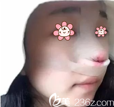 术后即刻 术后即刻