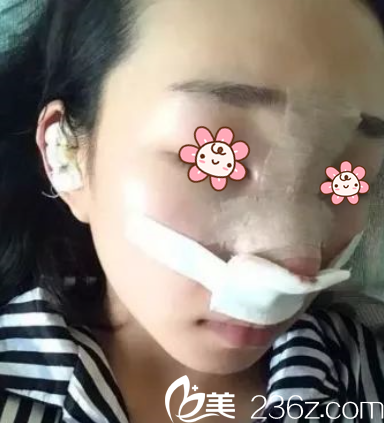 马上就能拆线了! 马上就能拆线了!