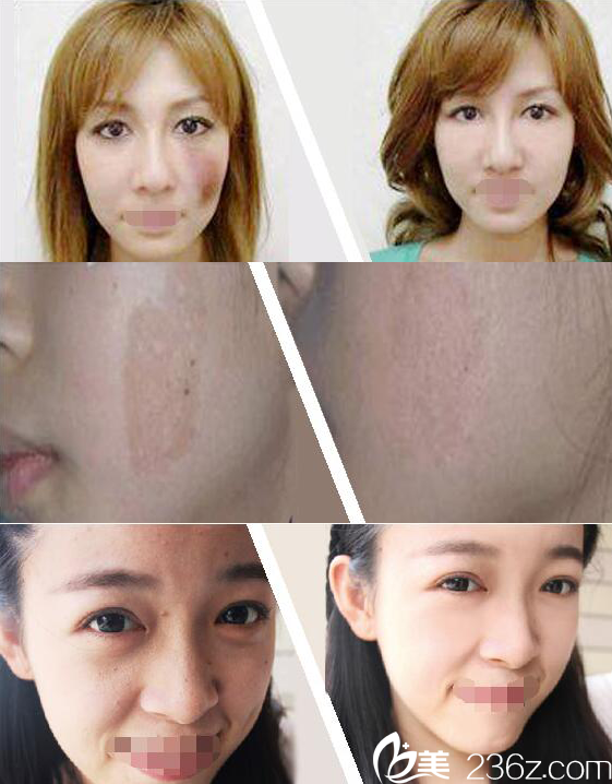 激光治疗前后对比