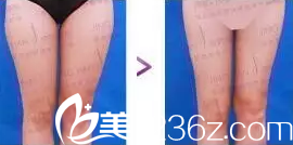 北京京韩王沛森医生腿部吸脂塑形案例 北京京韩王沛森医生腿部吸脂塑形案例