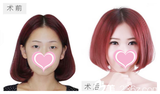 真人双眼皮前后效果展示 真人双眼皮前后效果展示