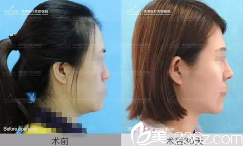 鼻部整形真人前后效果对比 鼻部整形真人前后效果对比