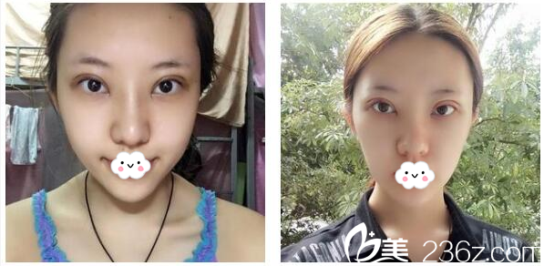 广州曙光医院双眼皮术后7天恢复过程图