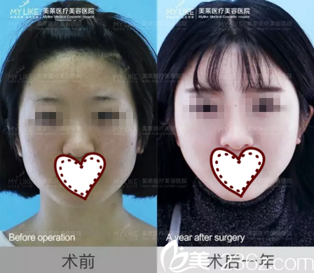 假体隆鼻+面部自体脂肪填充前后效果对比