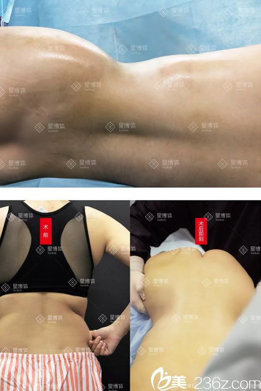 直播杭州星博体（原博雅）宫瑞成腰腹吸脂手术打造S腰手术过程及效果