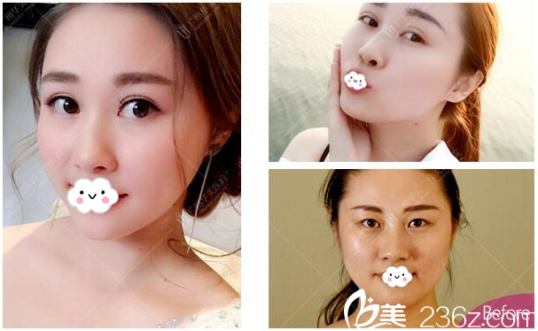 广州华美整形医院阮庆玲切开双眼皮效果