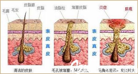 痘痘的形成过程