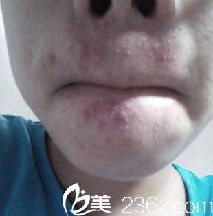 郑州梨花雨激光祛痘