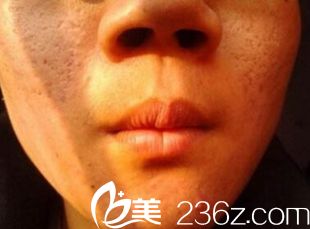 郑州梨花雨激光祛痘坑痘印