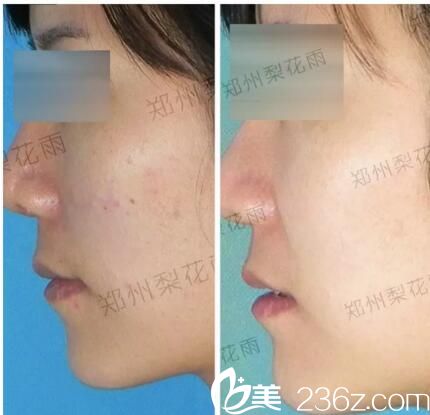 郑州梨花雨祛痘案例