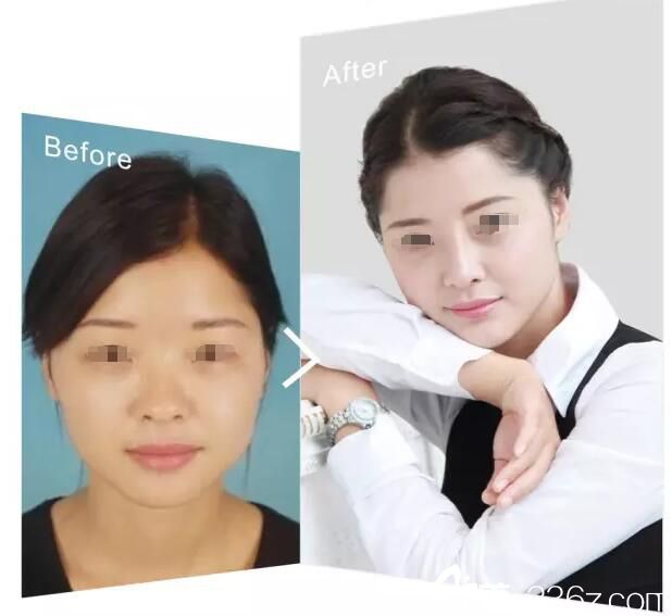 淮安华美鼻综合整形案例 淮安华美鼻综合整形案例