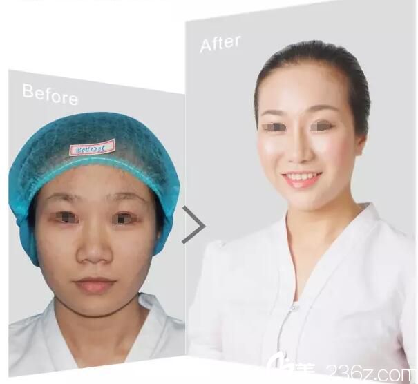 院内员工做鼻综合整形案例 院内员工做鼻综合整形案例