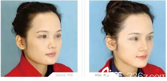 淮安华美玻尿酸注射隆鼻案例 淮安华美玻尿酸注射隆鼻案例