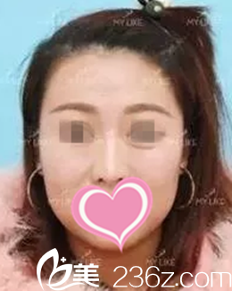 术前鼻子样子 术前鼻子样子