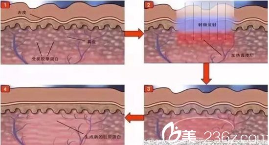彩光嫩肤原理 彩光嫩肤原理
