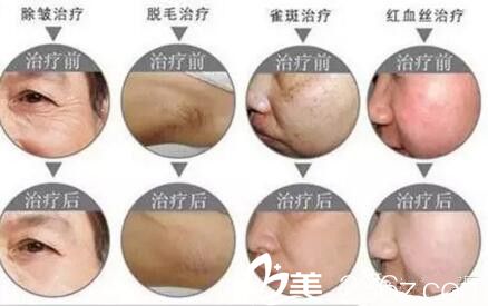 郑州梨花雨做激光祛痘嫩肤彩光嫩肤治疗效果 郑州梨花雨做激光祛痘嫩肤彩光嫩肤治疗效果