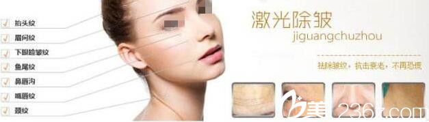 激光除皱适合面部的部位 激光除皱适合面部的部位