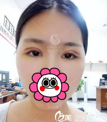 在北海韩美做双眼皮+开眼角手术后1天