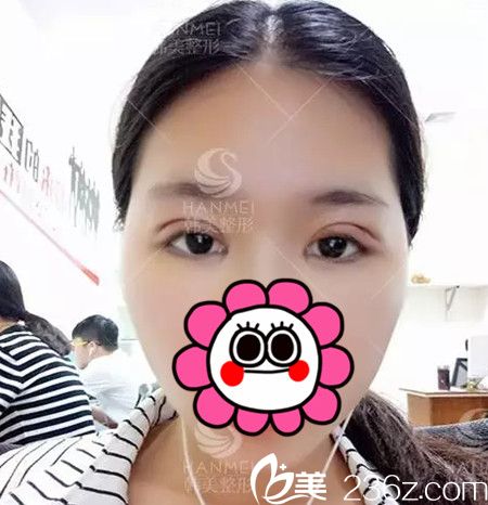 在北海韩美做双眼皮+开眼角手术后3天