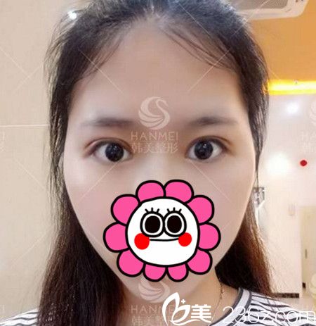 快看看我在北海韩美做双眼皮+开眼角手术后7天的效果好不好