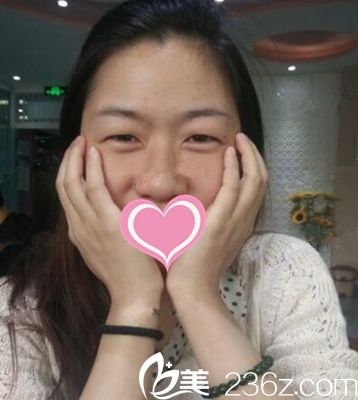 郑州芳艺双眼皮手术案例 郑州芳艺双眼皮手术案例