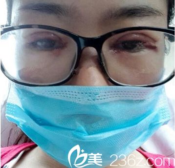 郑州芳艺双眼皮手术当天 郑州芳艺双眼皮手术当天