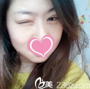 郑州芳艺做的全切双眼皮让我大开电眼 术后睫毛也翘了