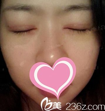 双眼皮手术后14天闭眼照