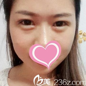 双眼皮手术后14天 双眼皮手术后14天