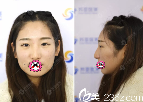 术前单眼皮、塌鼻子 术前单眼皮、塌鼻子