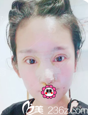 做完眼、鼻综合整形3天后的样子 做完眼、鼻综合整形3天后的样子